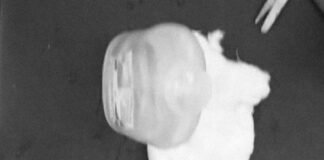 భువనగిరిలో హృదయ విధారక ఘటన….* *4 ఏళ్ల బాబుపై కుక్క దాడి.* *కన్ను గుడ్డు బయటపడేంత తీవ్రంగా కరిసిన కుక్క.*