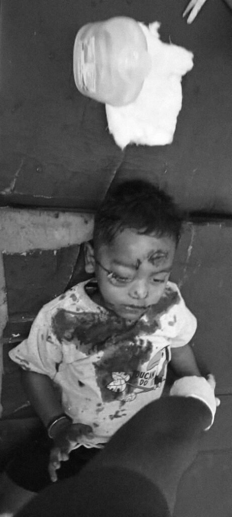 భువనగిరిలో హృదయ విధారక ఘటన….*     *4 ఏళ్ల బాబుపై కుక్క దాడి.*     *కన్ను గుడ్డు బయటపడేంత తీవ్రంగా కరిసిన కుక్క.*